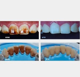 کیت پاک کننده stain دندانی | Antivet Kit کیت پاک کننده stain دندانی | Antivet Kit