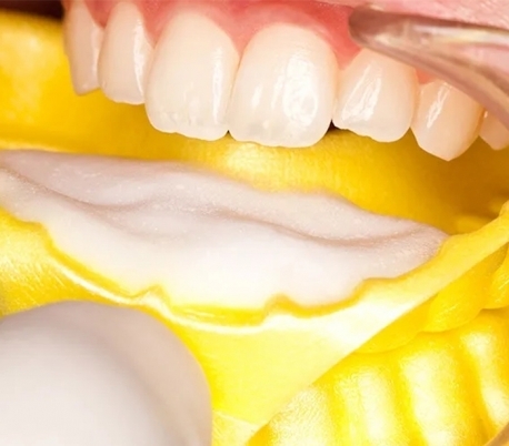 تری فلورایدتراپی یکبارمصرف کوتیزن Cotisen - تری یکبارمصرف فومی فلوراید کوتیزن Cotisen Disposable Fluoride Foam Trays تری فلورایدتراپی یکبارمصرف کوتیزن Cotisen - تری یکبارمصرف فومی فلوراید کوتیزن Cotisen Disposable Fluoride Foam Trays