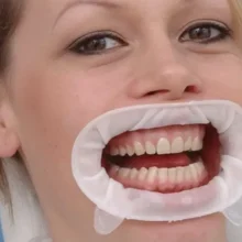 دهان بازکن اپتراگیت ایوکلار IVOCLOR optragate