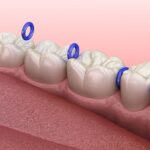 سپریتور دندانپزشکی ?- سپریتور ارتودنسی - سپراتور ارتودنسی - جدا کننده فاصله انداز ارتودنسی