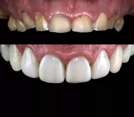 قالب پیش ساخته کامپوزیت بزرگ U Veneer Extra برند Ultradent - کیت قالب آماده ونیر کامپوزیت UltraDent - Uveneer Extra - کیت قالب آماده ونیر کامپوزیت - قالب پیش ساخته کامپوزیت بزرگ قالب پیش ساخته کامپوزیت بزرگ U Veneer Extra برند Ultradent - کیت قالب آماده ونیر کامپوزیت UltraDent - Uveneer Extra - کیت قالب آماده ونیر کامپوزیت - قالب پیش ساخته کامپوزیت بزرگ