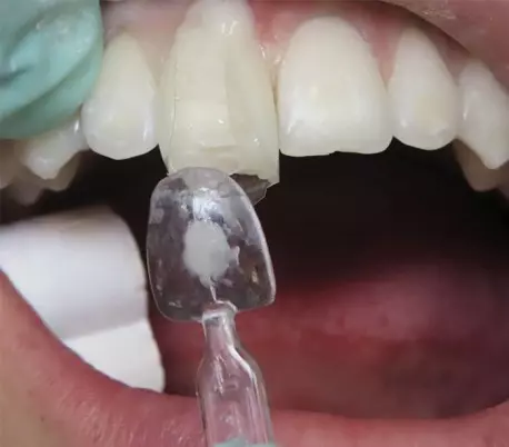 قالب پیش ساخته کامپوزیت بزرگ U Veneer Extra برند Ultradent - کیت قالب آماده ونیر کامپوزیت UltraDent - Uveneer Extra - کیت قالب آماده ونیر کامپوزیت - قالب پیش ساخته کامپوزیت بزرگ قالب پیش ساخته کامپوزیت بزرگ U Veneer Extra برند Ultradent - کیت قالب آماده ونیر کامپوزیت UltraDent - Uveneer Extra - کیت قالب آماده ونیر کامپوزیت - قالب پیش ساخته کامپوزیت بزرگ