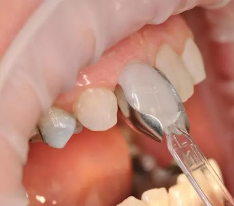 قالب پیش ساخته کامپوزیت بزرگ U Veneer Extra برند Ultradent - کیت قالب آماده ونیر کامپوزیت UltraDent - Uveneer Extra - کیت قالب آماده ونیر کامپوزیت - قالب پیش ساخته کامپوزیت بزرگ قالب پیش ساخته کامپوزیت بزرگ U Veneer Extra برند Ultradent - کیت قالب آماده ونیر کامپوزیت UltraDent - Uveneer Extra - کیت قالب آماده ونیر کامپوزیت - قالب پیش ساخته کامپوزیت بزرگ